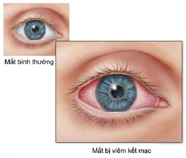 Trẻ bị đau mắt đỏ hậu COVID-19, cha mẹ nhất định phải nhớ điều này