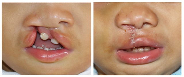 Phẫu thuật nhân đạo cho trẻ bị sứt môi, hở hàm ếch