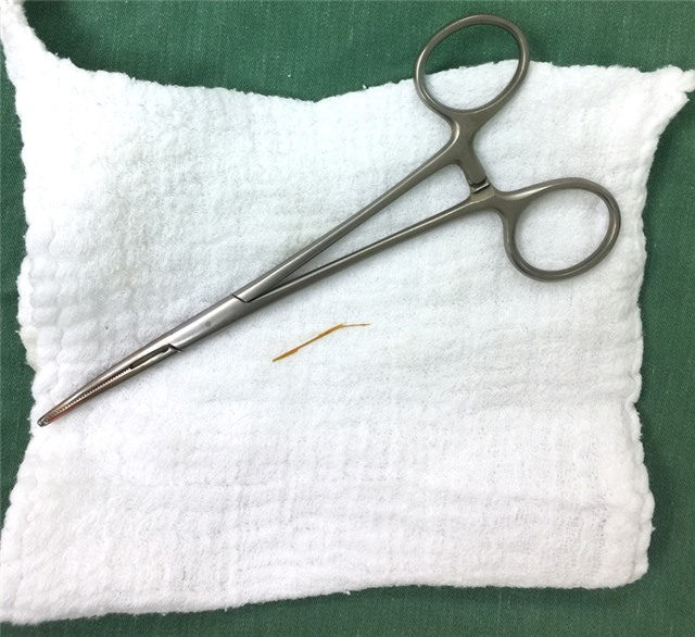 Viêm phúc mạc chỉ vì … 1 chiếc tăm