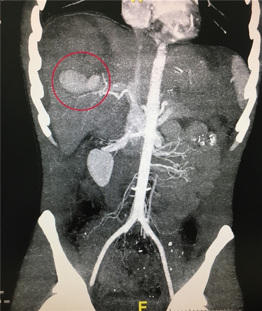 Nút động mạch gan điều trị vỡ gan cho bệnh nhân tại Bệnh viện Việt Nam-Thụy Điển Uông Bí