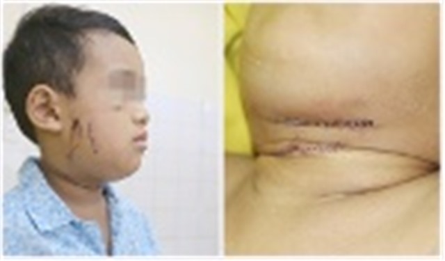Bé trai 4 tuổi bị chó cắn vào vùng cổ