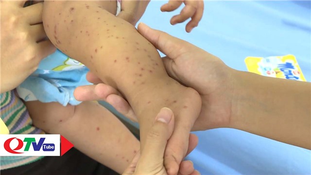 Quảng Ninh: Bệnh tay chân miệng có xu hướng tăng