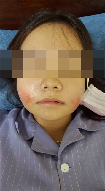 Cảnh báo chị em làm đẹp bằng chất làm đầy Filler