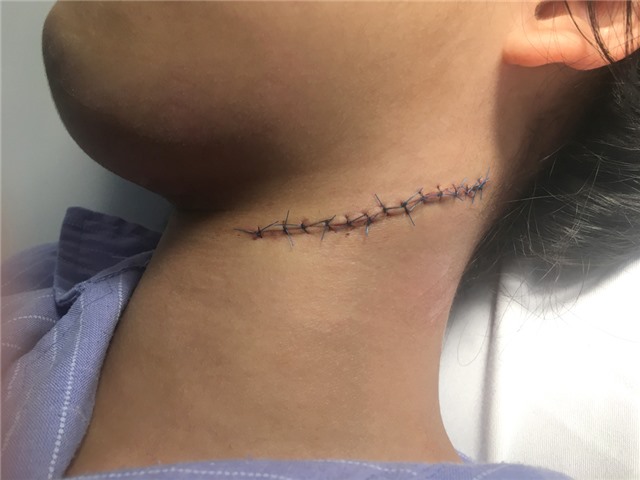 Vấp ngã cầu thang, bệnh nhi không may bị mảnh bát làm tổn thương vùng cổ