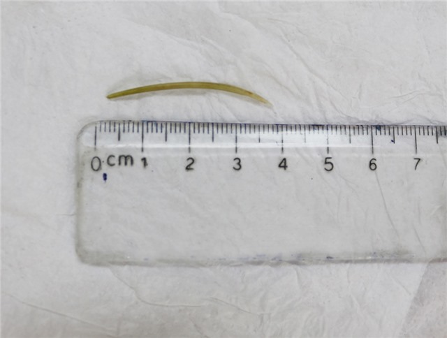 Cấp cứu người bệnh thủng quai ruột non do nuốt phải xương cá