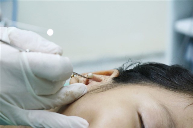 Dị vật ống tai không thể coi thường