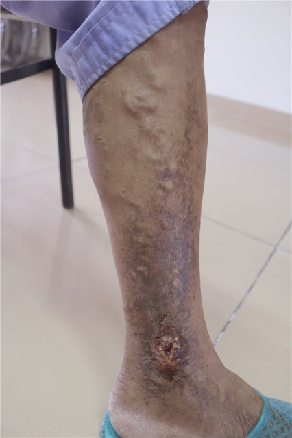 Không chủ quan với bệnh suy giãn tĩnh mạch