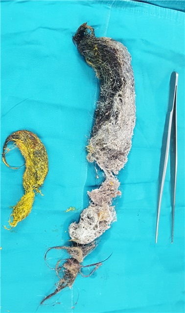 Cảnh báo tình trạng ăn dị vật bất thường ở trẻ nhỏ