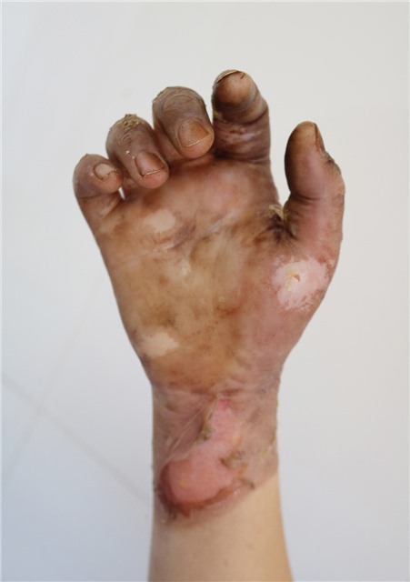 Cảnh báo một số trẻ em bị tai nạn do chơi nghịch