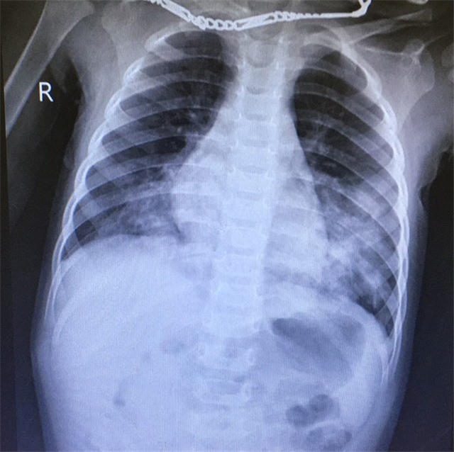 Bé 2 tuổi nhập viện cấp cứu do uống phải chất tẩy trắng giày dép