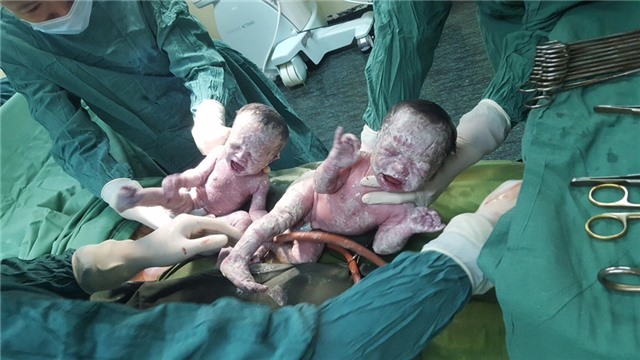 Hy hữu: sản phụ sinh đôi, 1 trong 2 bé còn nguyên trong túi ối