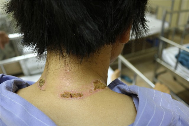 Bất tỉnh do bị sét đánh