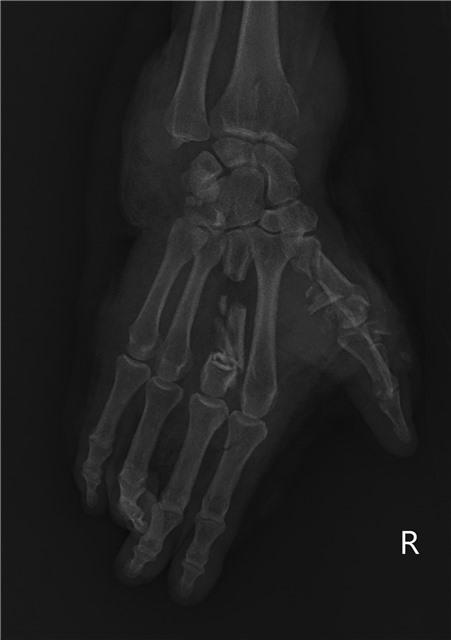 Tai nạn dập nát cổ tay, bàn tay vì máy xay đá