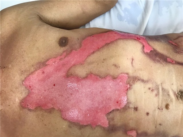 Bỏng 30% cơ thể vì bị sét đánh