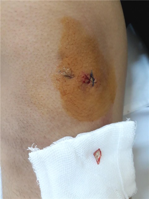 Mảnh gương vỡ nằm trong đầu gối sau một năm mới được phát hiện