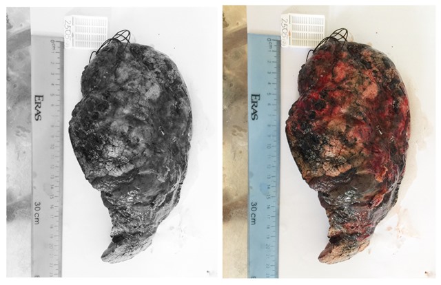 Hiếm gặp: Phát hiện 2 loại ung thư trên cùng thùy phổi