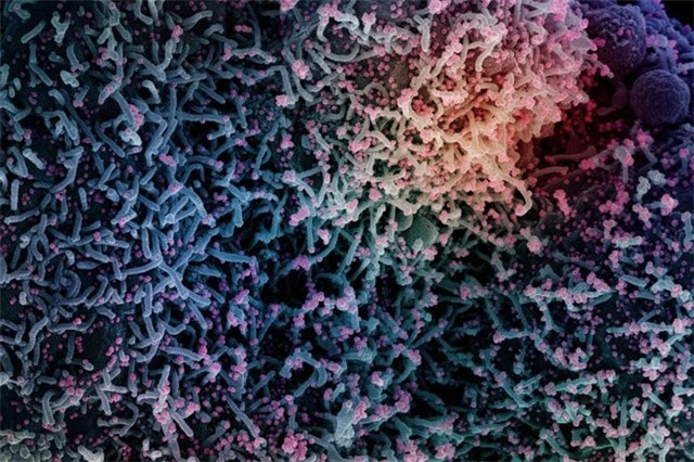 Phát hiện mới về nguyên nhân hiện tượng COVID-19 kéo dài