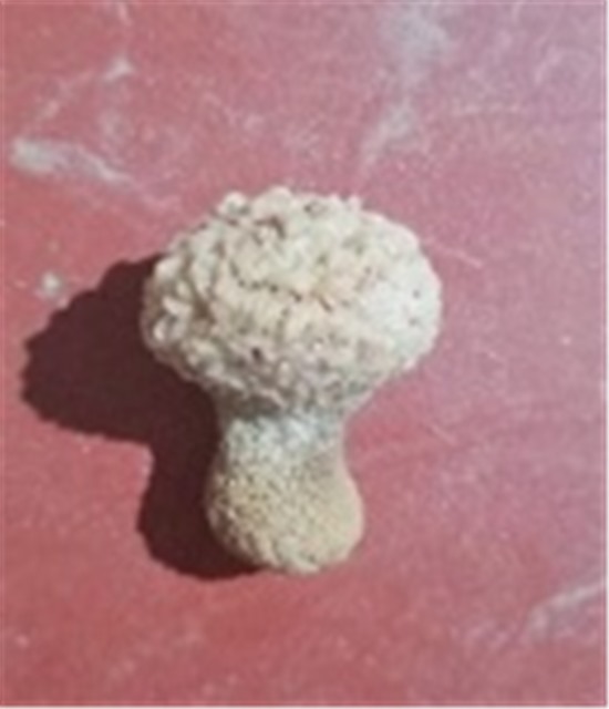 Lấy sỏi to hình nấm trong bàng quang bệnh nhân