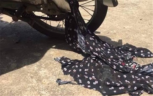 Vướng áo chống nắng, người phụ nữ bị ngã gãy xương cẳng tay