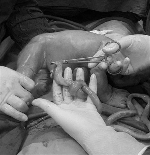 Cứu sống thai nhi bị thắt nút dây rốn, suy thai