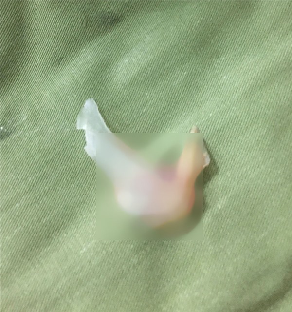 Vừa ăn cơm vừa sử dụng điện thoại, người đàn ông nhập viện vì hóc xương cá