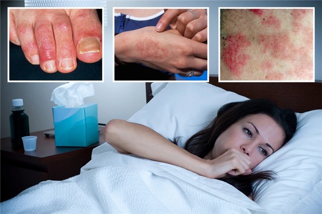 Ba dấu hiệu trên da cảnh báo nhiễm biến thế Omicron