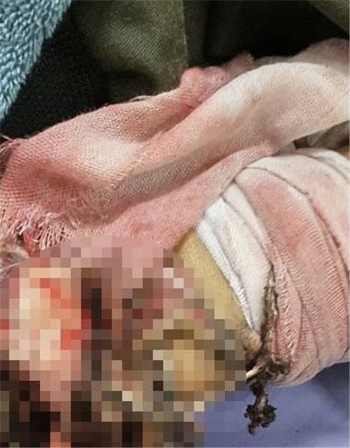 Tai nạn do nổ bình gas mini