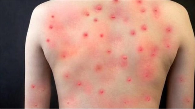 Cần biết: 6 biện pháp phòng chống dịch bệnh đậu mùa khỉ