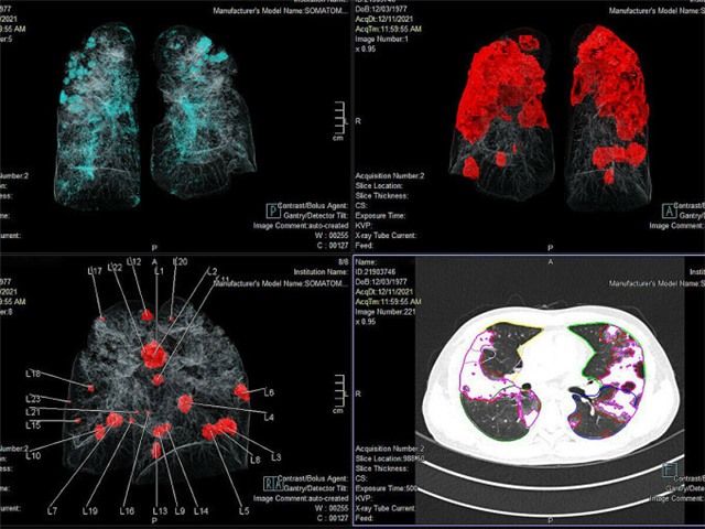 Di chứng phổi nặng ở F0 ít triệu chứng