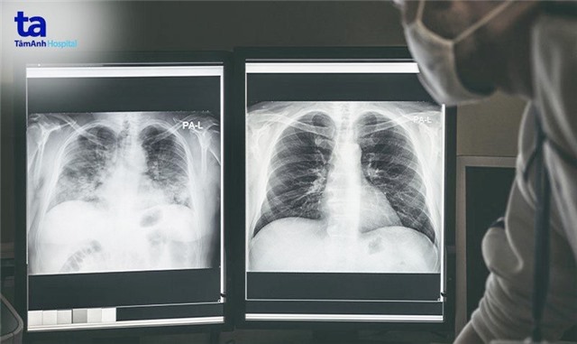 Những điều cần biết về hậu COVID-19 