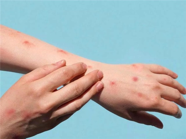 Việt Nam siết kiểm dịch y tế biên giới phòng các dịch bệnh nguy hiểm, mới nổi