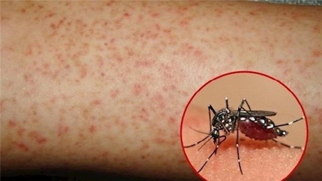 Phòng tránh bệnh sốt xuất huyết 