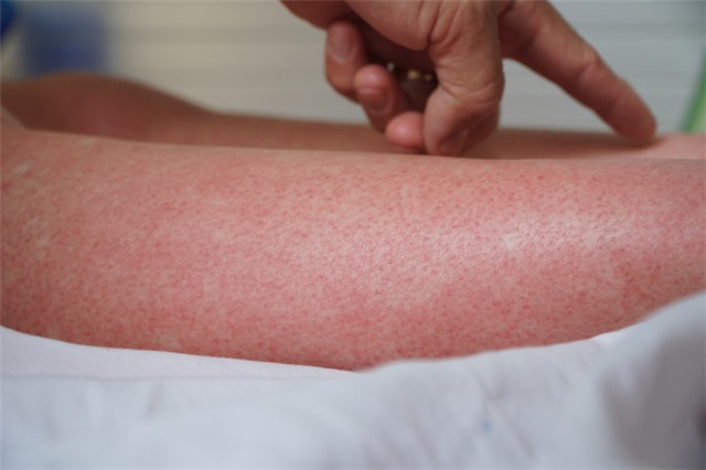 5 bệnh dễ mắc vào mùa mưa