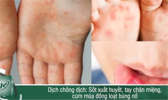 Nguy cơ dịch chồng dịch khi sốt xuất huyết, tay chân miệng, cúm mùa đồng loạt bùng nổ