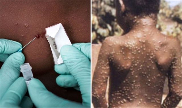 Sáng 25/7: Tiếp tục giám sát sự lưu hành của biến thể phụ BA.4, BA.5; đã có vaccine phòng đậu mùa khỉ thế hệ mới