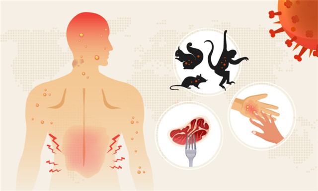Cách bảo vệ bản thân không mắc đậu mùa khỉ