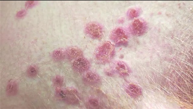 Ba triệu chứng nặng cần lưu ý của bệnh đậu mùa khỉ