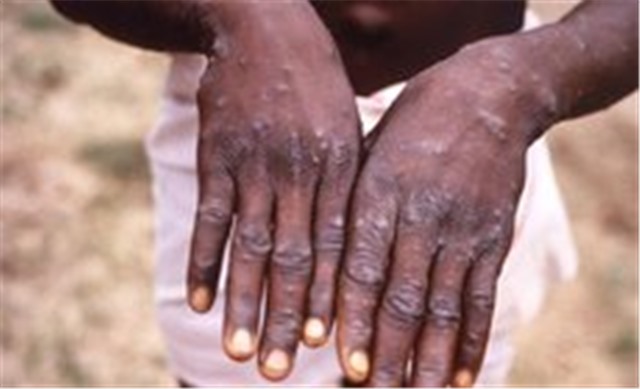 Chuyên gia WHO tại Việt Nam nói gì về nguy cơ bệnh đậu mùa khỉ xâm nhập vào nước ta?