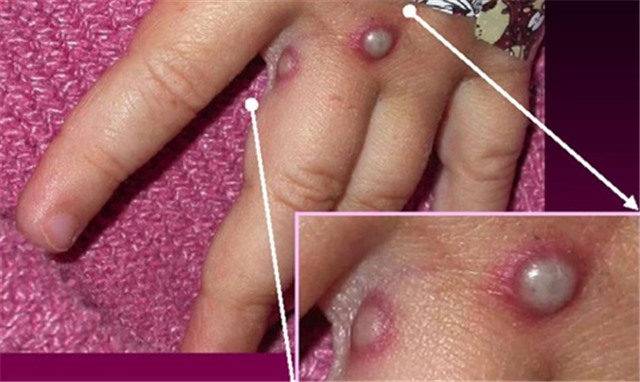 Sáng 2/8: Những tình huống nào ứng phó với bệnh đậu mùa khỉ ở Việt Nam? Biến thể phụ BA.4, BA.5 lây lan nhanh