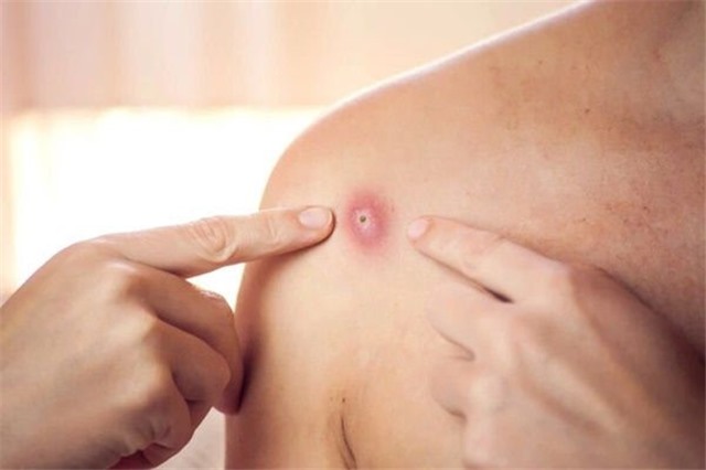 Bộ Y tế hướng dẫn cách phòng ngừa lây nhiễm bệnh đậu mùa khỉ tại cơ sở y tế