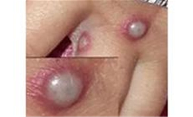 Nhận biết phát ban đậu mùa khỉ