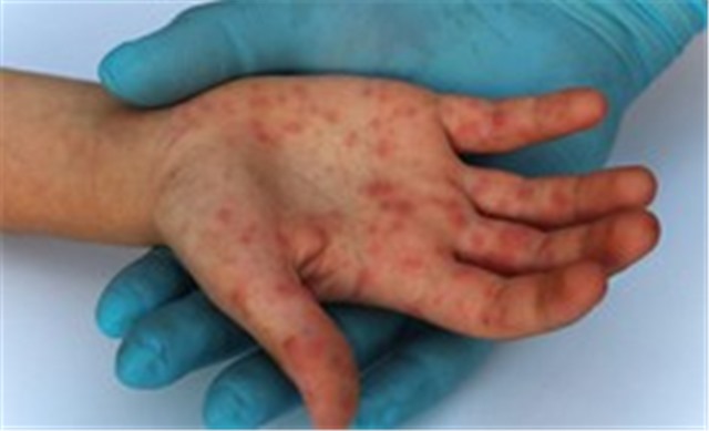 Ca đậu mùa khỉ đầu tiên ở Long An hàng ngày đi làm tại TPHCM