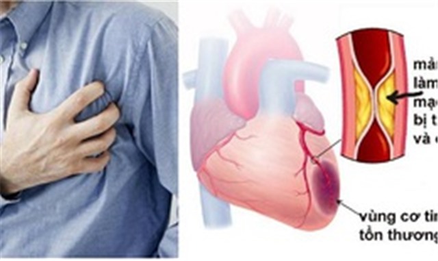 4 yếu tố gây nhồi máu cơ tim cấp cần lưu ý