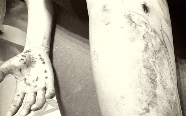 Thiếu niên 15 tuổi bị đa chấn thương do điện thoại phát nổ khi vừa dùng vừa sạc