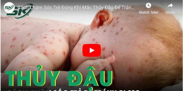 Cách chăm sóc trẻ đúng khi mắc thủy đậu để tránh bị sẹo