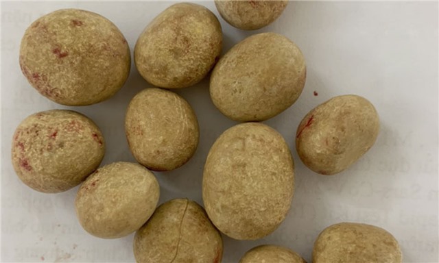 Cụ ông 83 tuổi được phẫu thuật lấy 12 viên sỏi bàng quang kích thước "khủng"