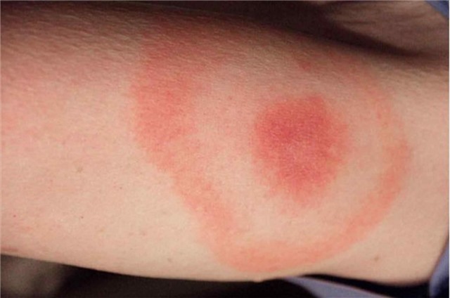 Không chủ quan khi trẻ bị côn trùng đốt