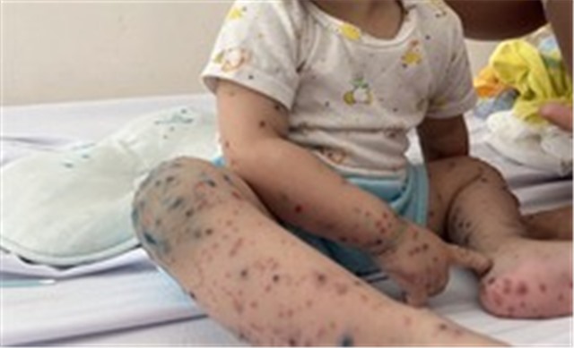 5 dấu hiệu cần cho trẻ mắc tay chân miệng nhập viện gấp