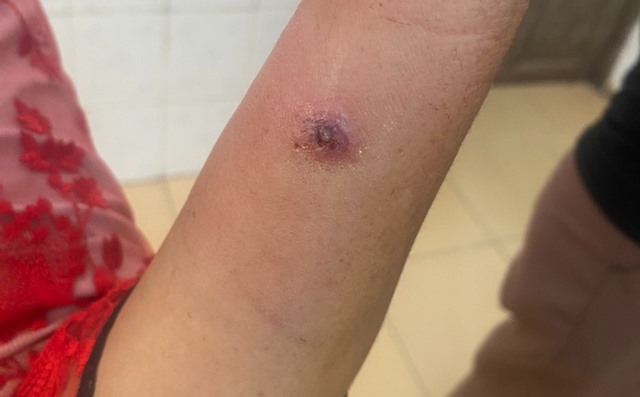 Điện Biên ghi nhận trường hợp trẻ nhỏ mắc bệnh than