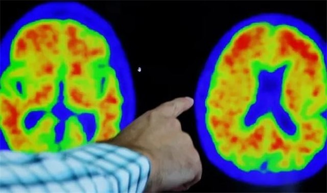 Thuốc donanemab - đột phá trong việc điều trị bệnh Alzheimer